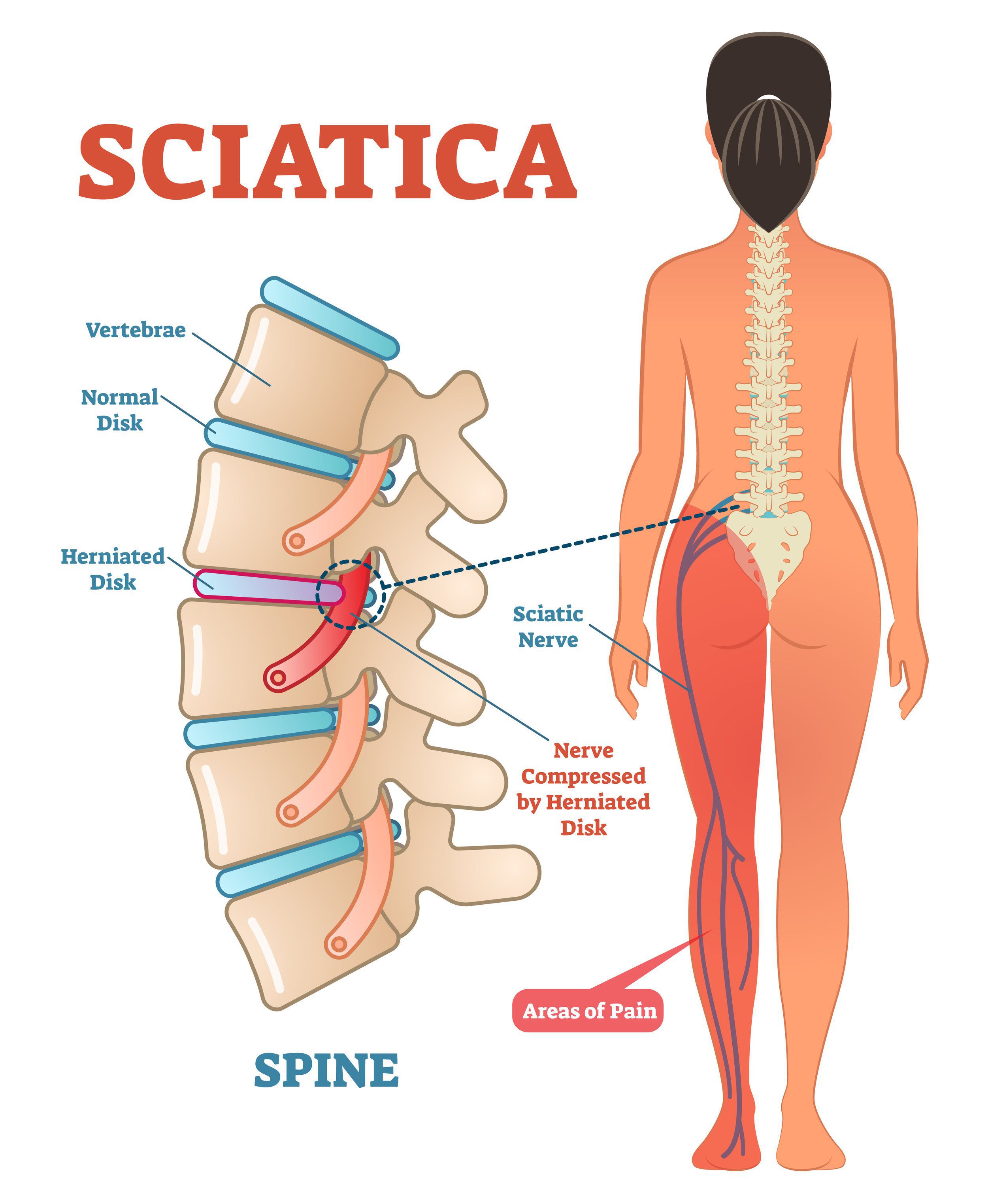 Sciatica – Symptoms and Causes