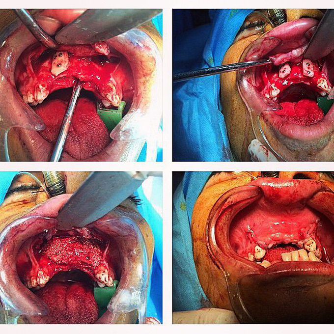 Lateral augmentation of the maxillary anterior region with autologous graft harvest (ramus bone graft)