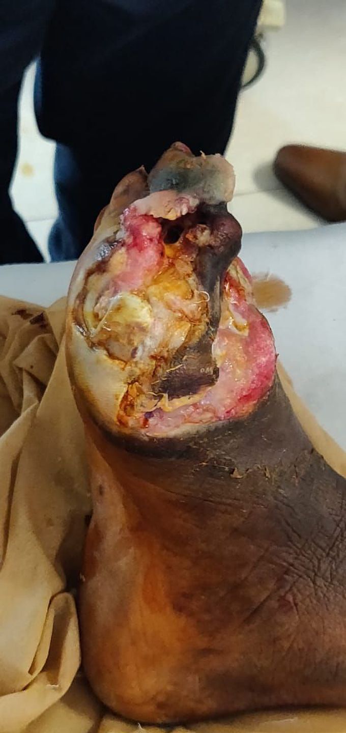 Diabetic foot