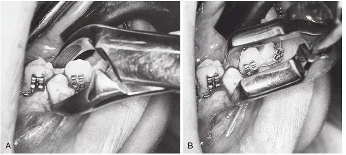 Luxation of adjacent tooth