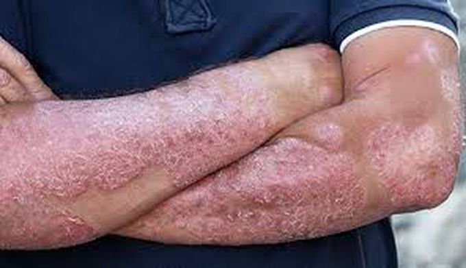 Psoriasis