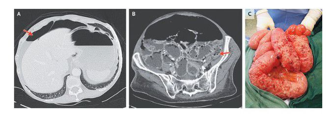 Pneumatosis Cystoides Intestinalis with Pneumoperitoneum