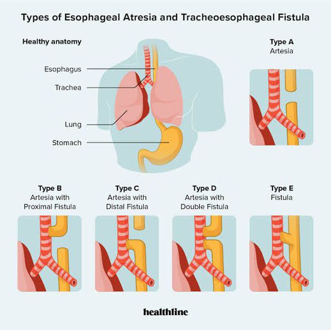 Esophageal atresia and tracheoesophageal fistula