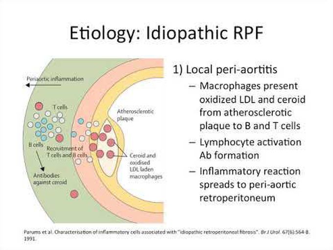 Retroperitoneal Fibrosis: Overview