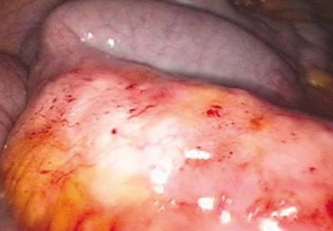 Crohn's disease