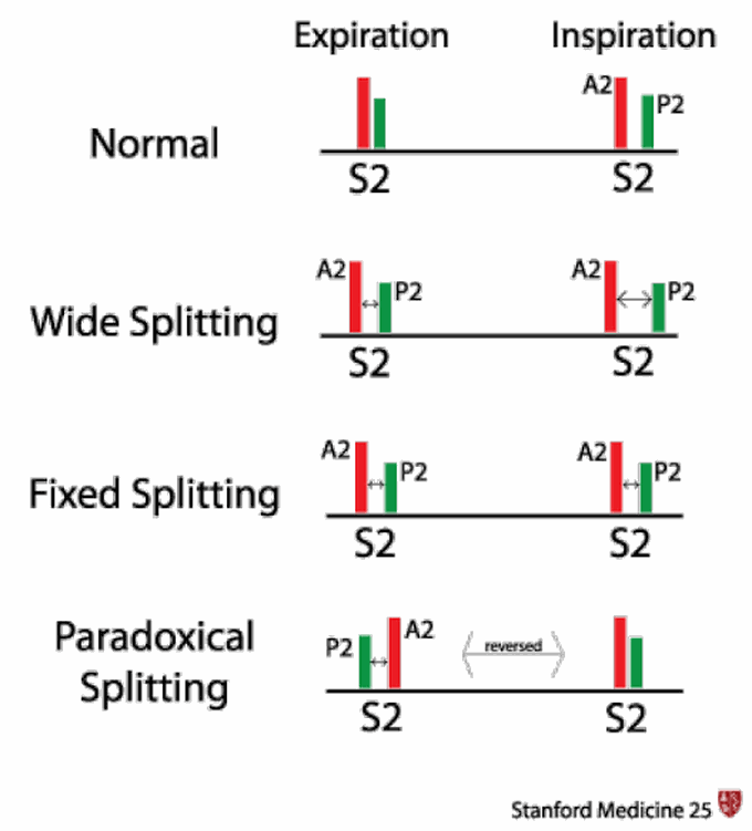 Second heart sound splitting