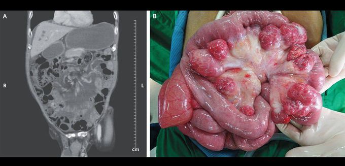 Mesenteric Volvulus from Jejunal Diverticulosis