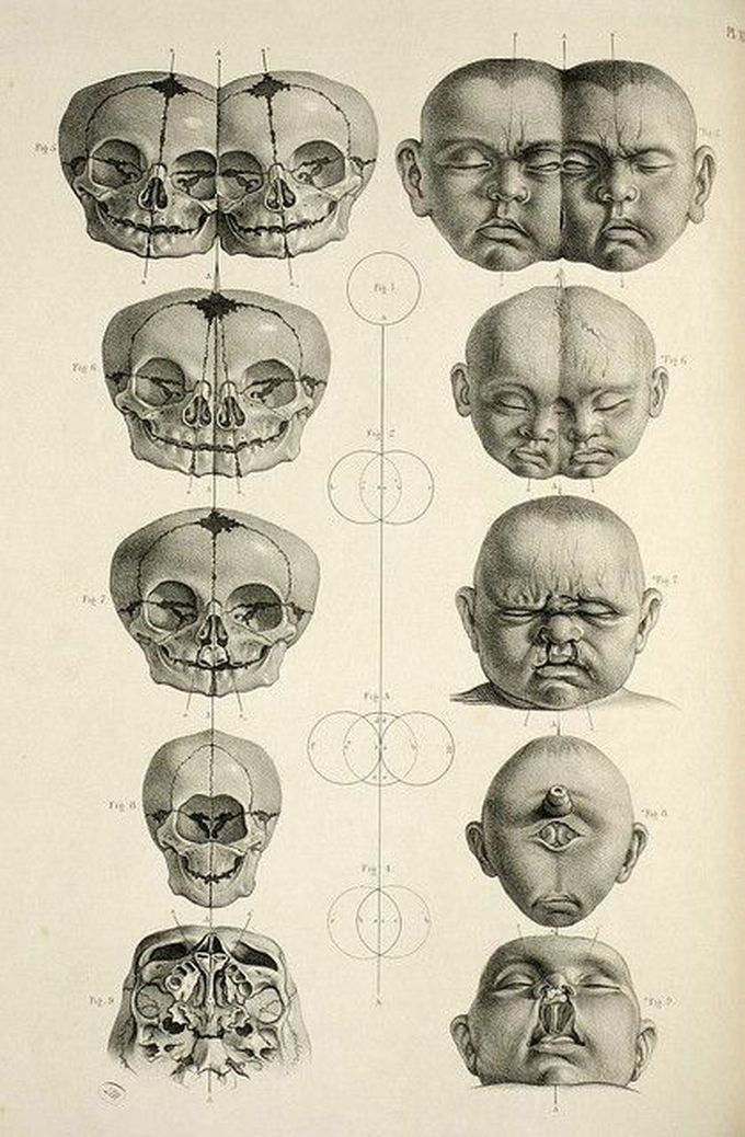 Figures of Skeletons of conjoines twins