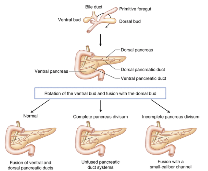 Cause of pancreatic divisum