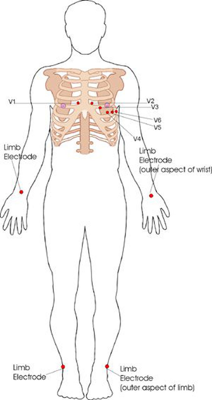 ECG Lead Placement