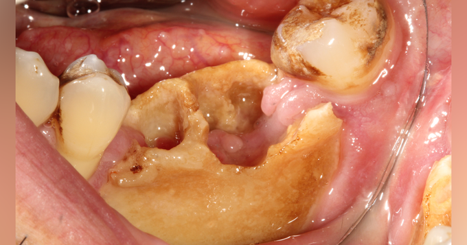Therapeutic Agents and Osteonecrosis of the Jaw