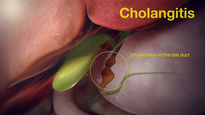 Treatment for Cholangitis