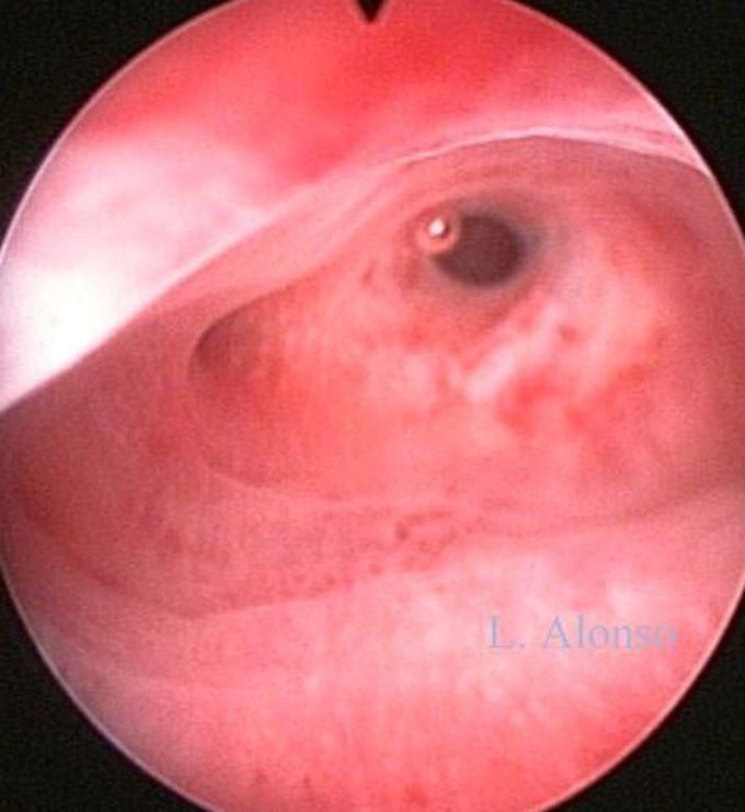Hysteroscopy