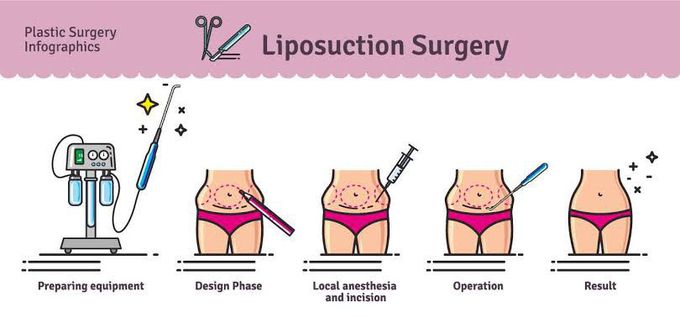 Types of liposuction