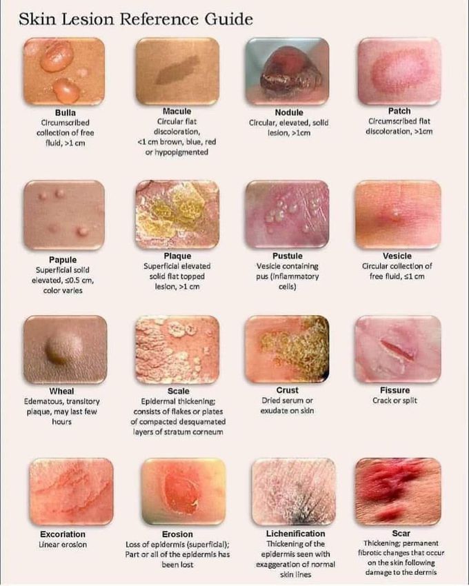 Skin lesion