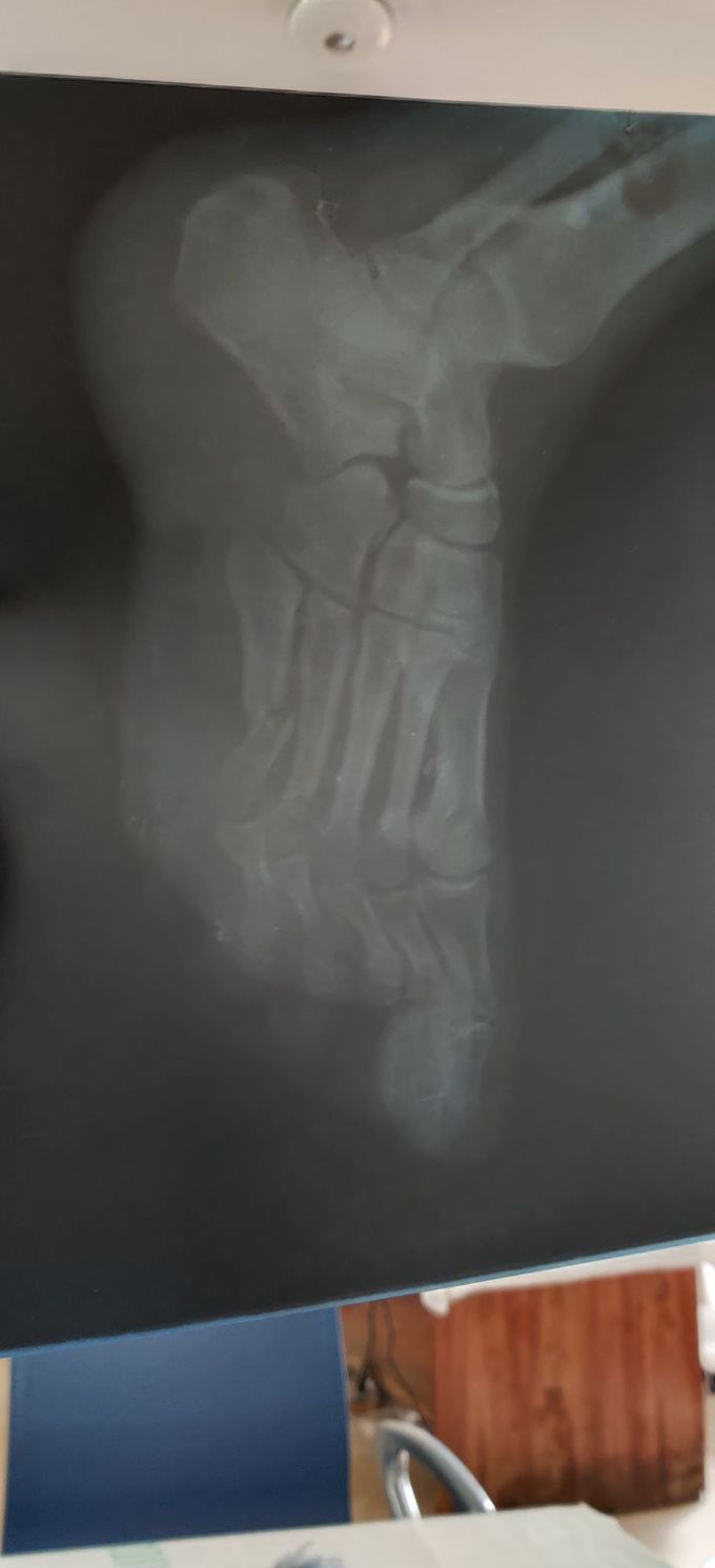 Fx 5th Metatarsal