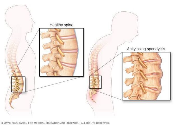 Symptoms of spondylitis