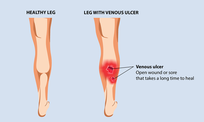 Venous leg ulcer