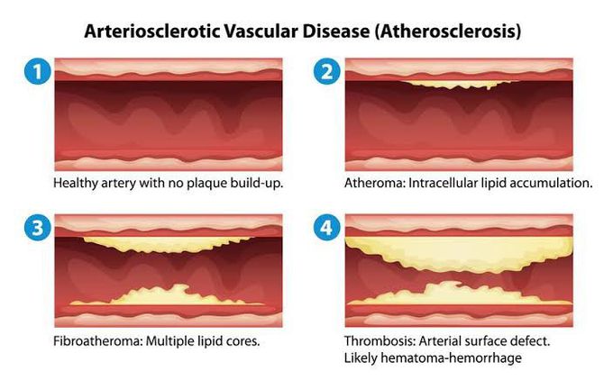 Atherosclerosis Stages