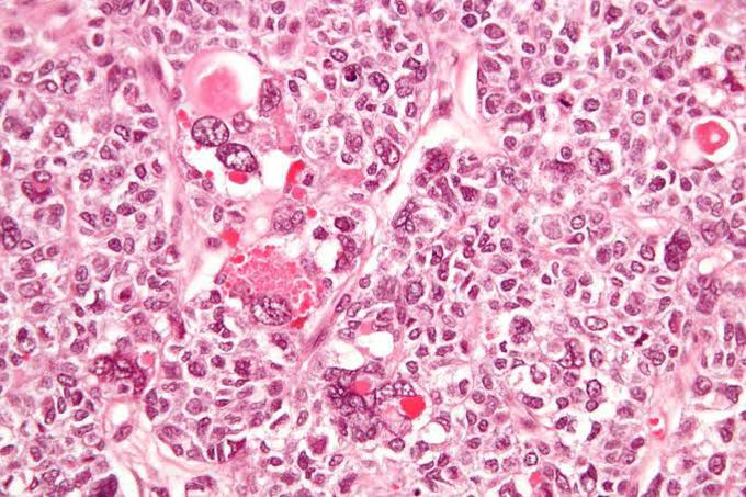 Granulosa cell tumor