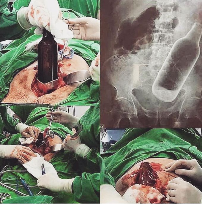 Poor(!) Rectum