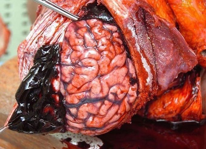 Hematoma
