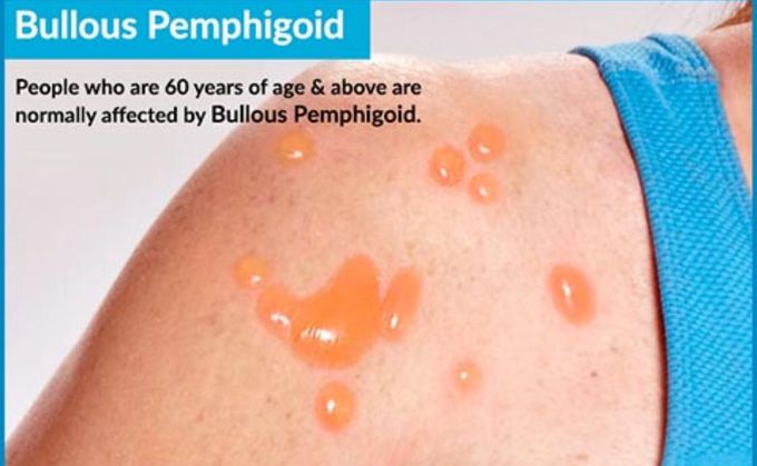 Bullous pemphigoid