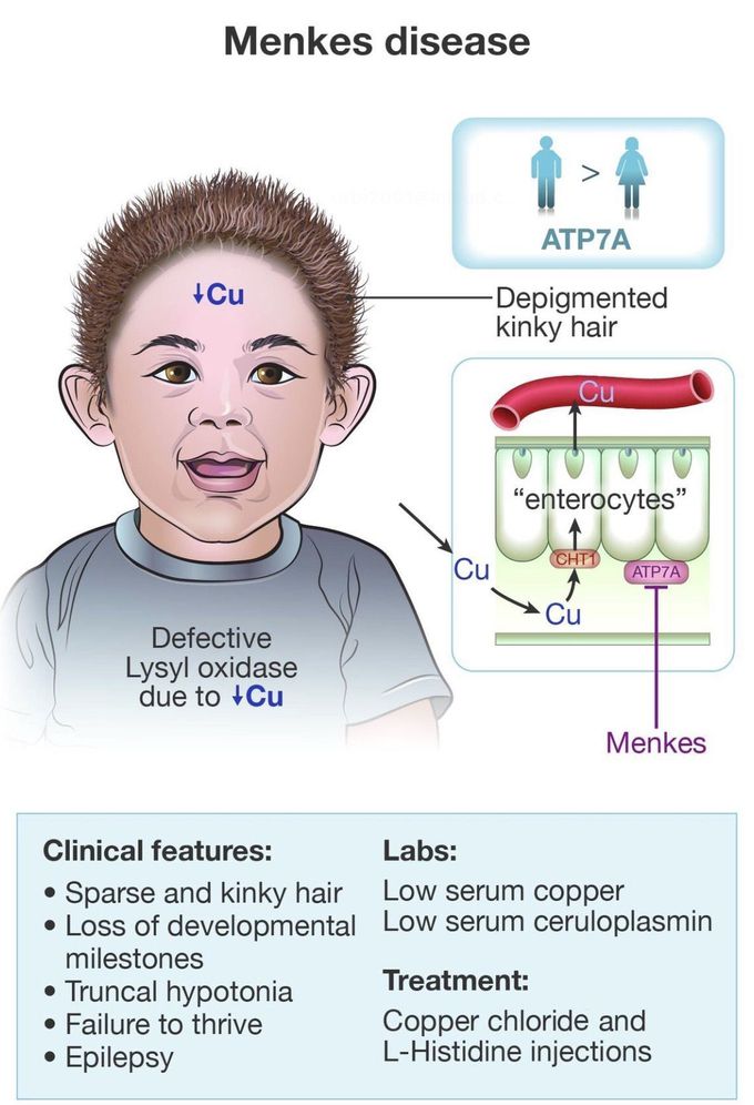 Menkes Disease