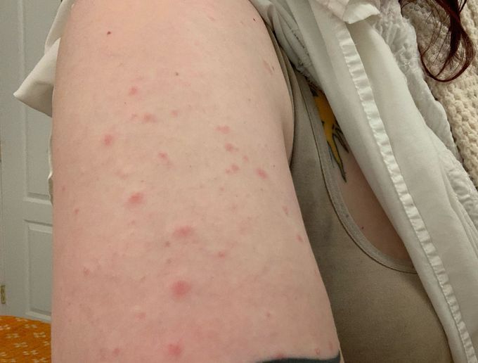 Rash appeared on hands and arms. It is not itchy nor does it hurt. Any ideas?