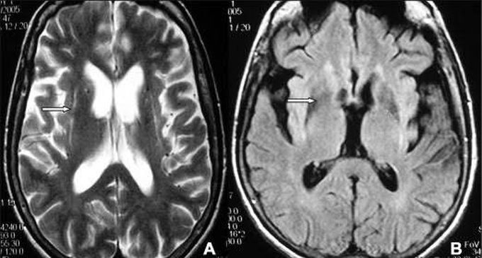 Multiple System Atrophy Cause