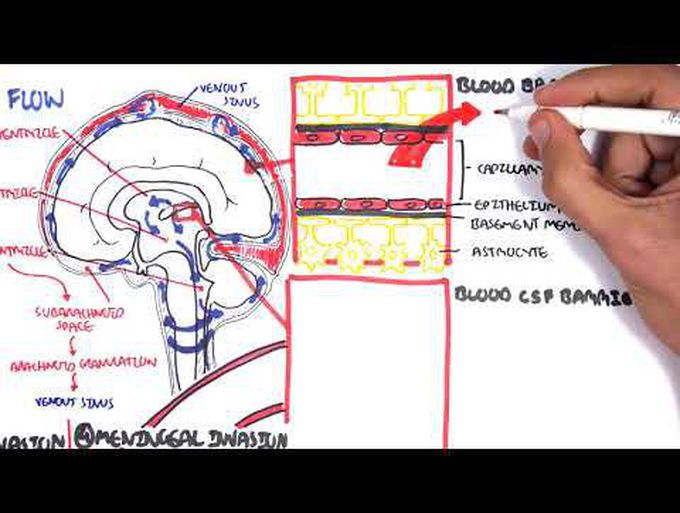 Bacterial Meningitis: Overview