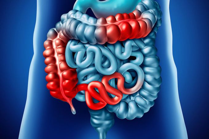 Radiological Features of Crohn Disease