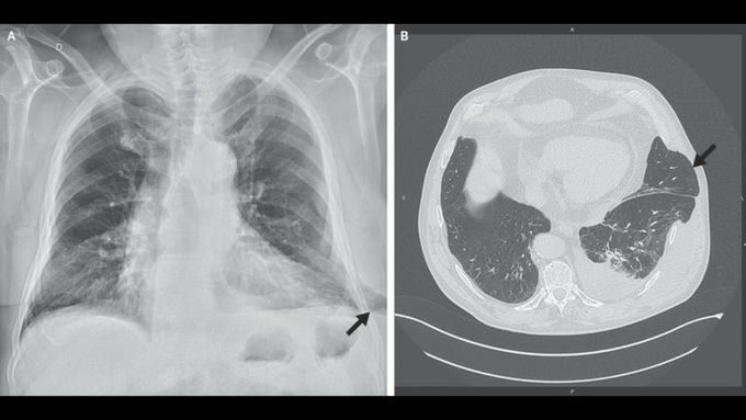 Lung Herniation with Coughing