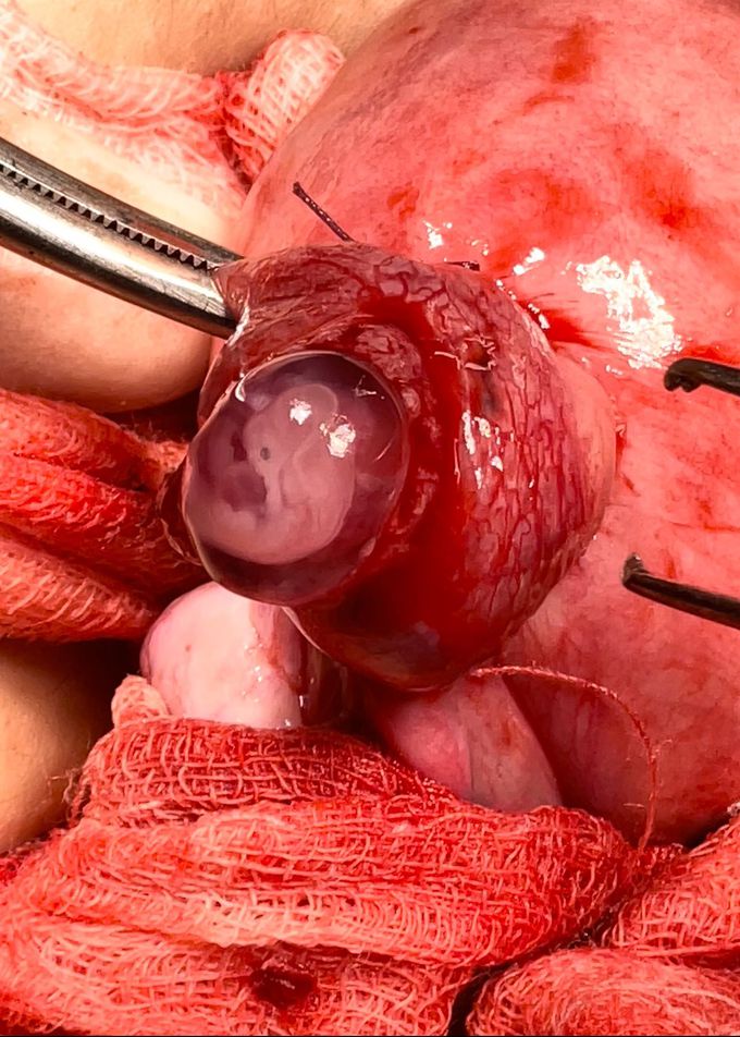 An embryo 8 weeks in ectopic pregnancy surgery.