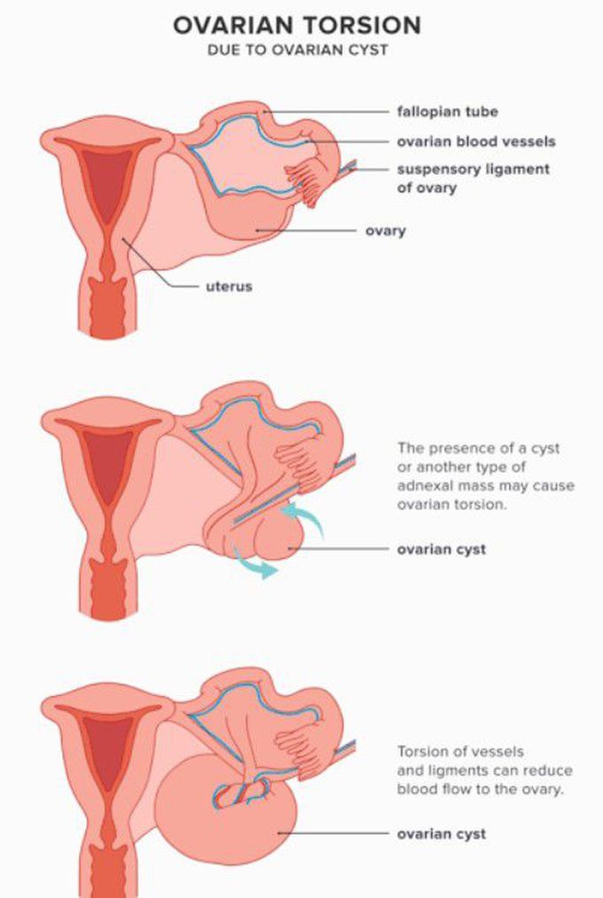 Cause of Ovarian torsion