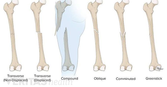 Fractures