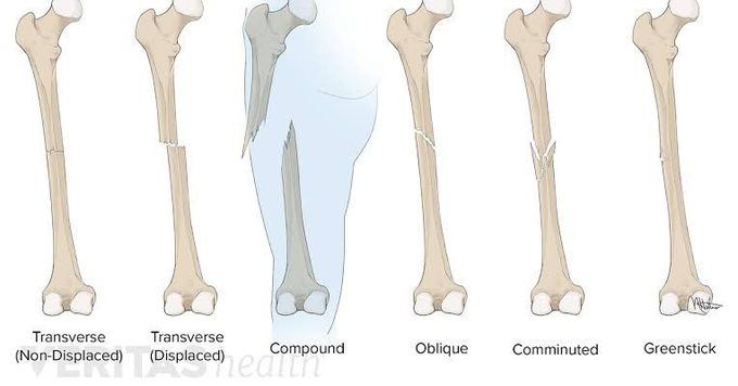 Fractures - MEDizzy