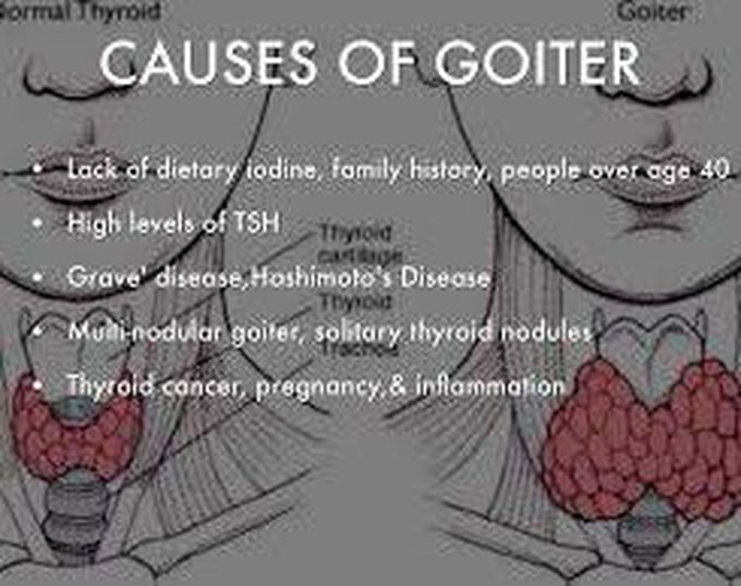 Causes of goiter