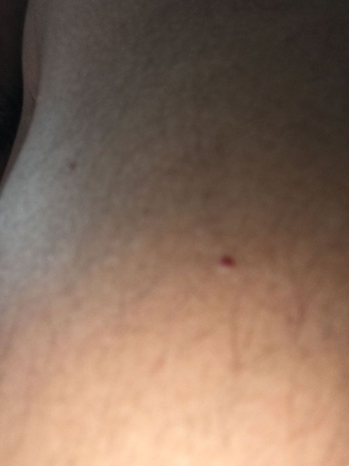 Skin lesions