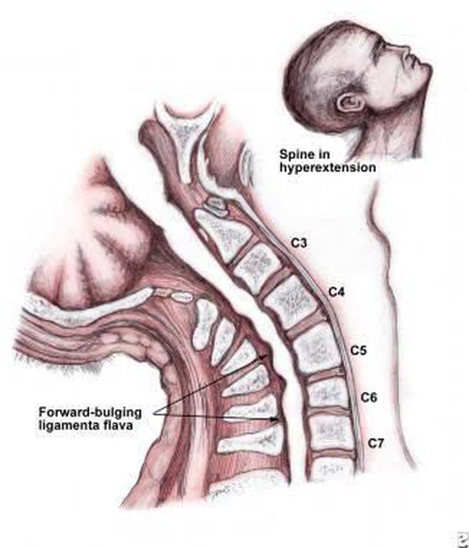 Cause of central cord syndrome