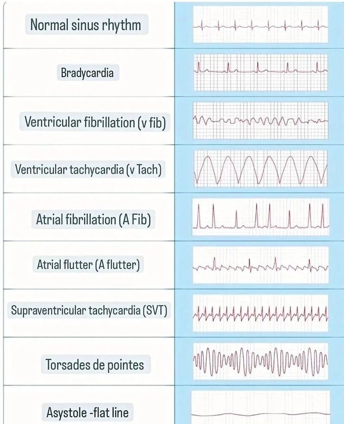 Common Arrhythmias