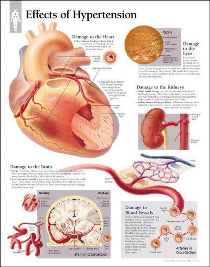 High Blood Pressure
