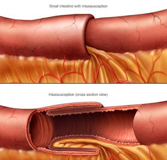 Symptoms of intussusception