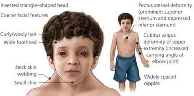 Noonan syndrome