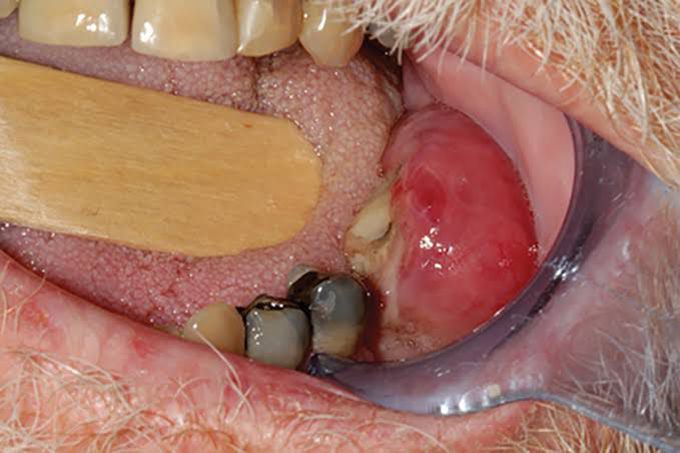 Ulocarcinoma - a metastatic adenocarcinoma of lungs in the gums