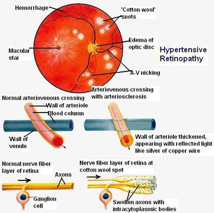 Retinopathy