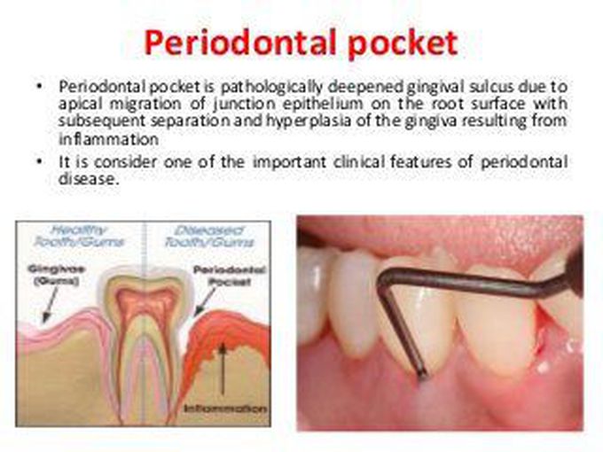 Periodontal pockets