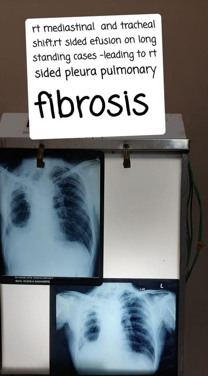 PLEUROPULMONARY FIBROSIS