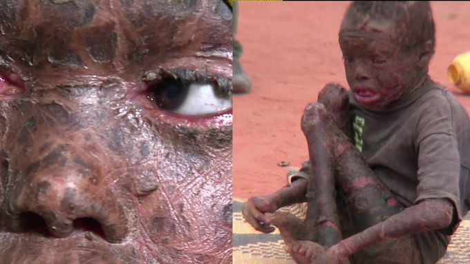 Kenyan Children Suffer from Skin Disease with no cure.
