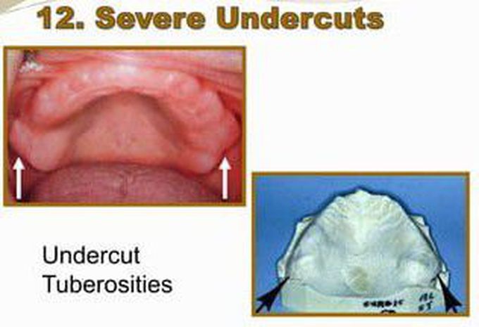 Severe Undercuts
